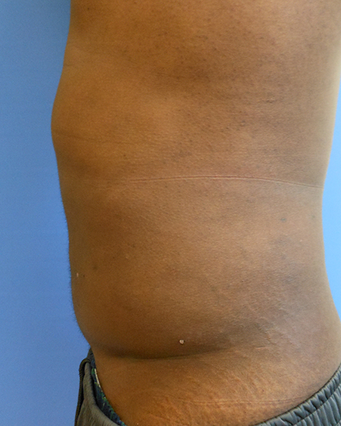 Abdomen Before & After Gallery - Patient 51821679 - Image 4