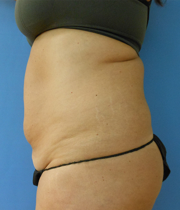 Abdomen Before & After Gallery - Patient 51821524 - Image 1