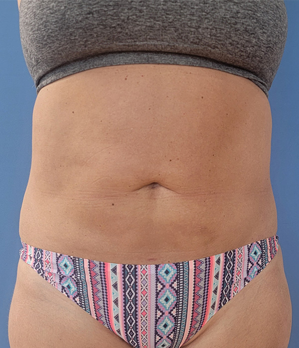 Abdomen Before & After Gallery - Patient 51821524 - Image 4