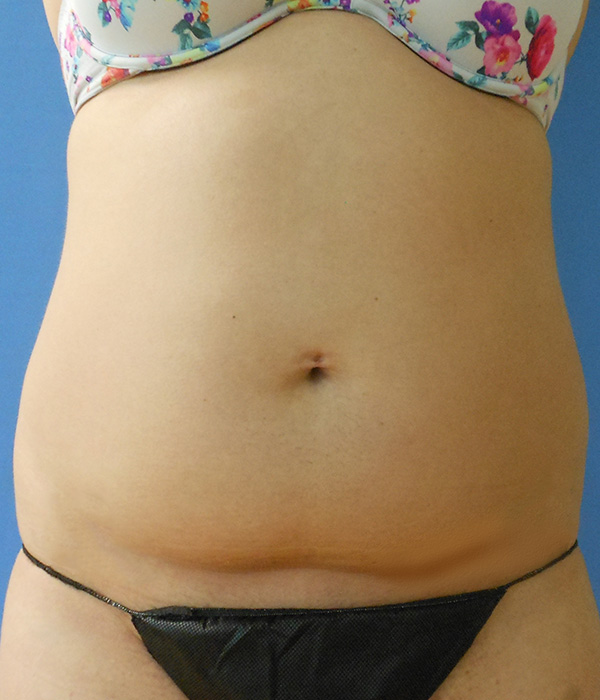 Abdomen Before & After Gallery - Patient 51821525 - Image 3