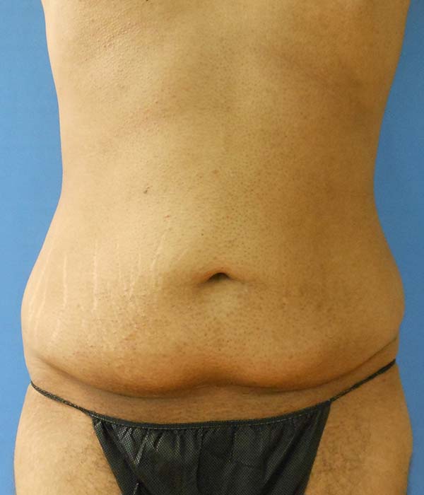 Abdomen Before & After Gallery - Patient 51821526 - Image 3