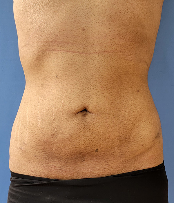 Abdomen Before & After Gallery - Patient 51821526 - Image 4
