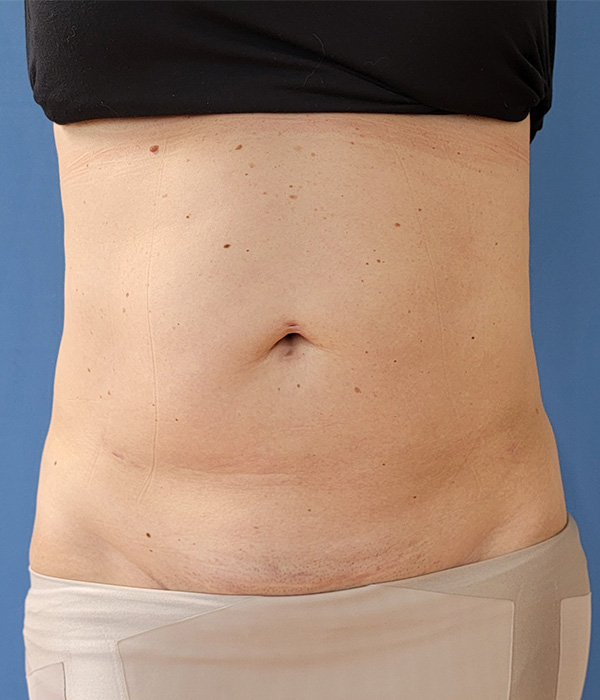 Abdomen Before & After Gallery - Patient 51821543 - Image 2