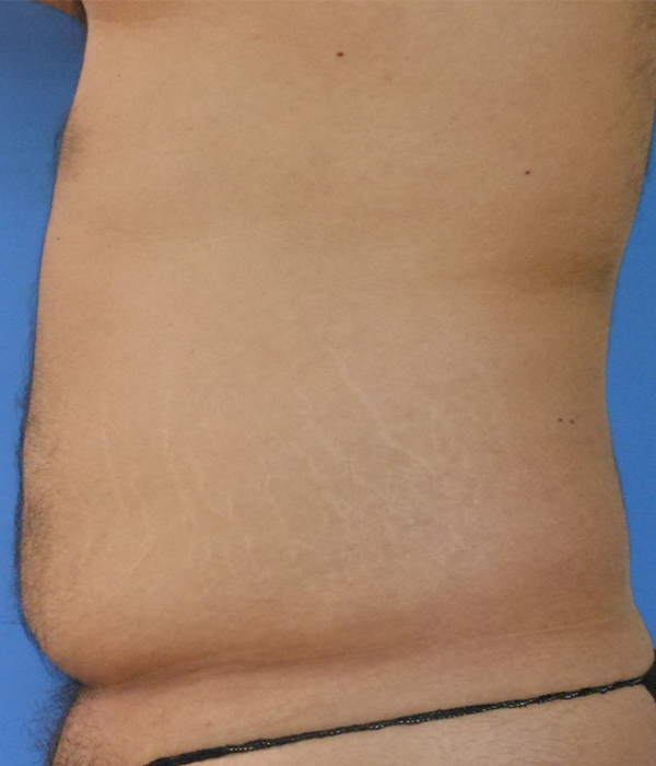 Abdomen Before & After Gallery - Patient 51821545 - Image 1