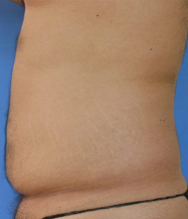Abdomen Before & After Gallery - Patient 51821545 - Image 1