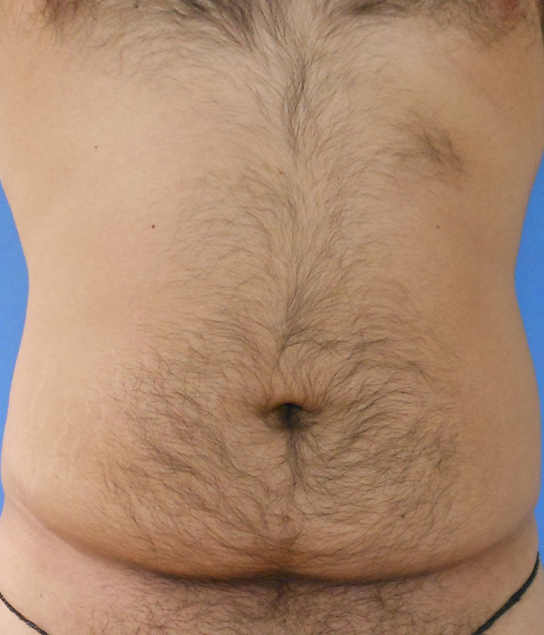 Abdomen Before & After Gallery - Patient 51821545 - Image 3