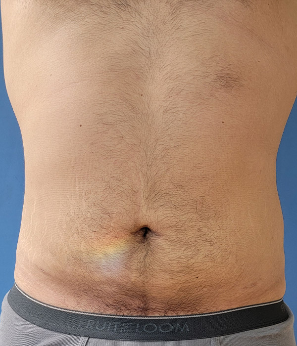 Abdomen Before & After Gallery - Patient 51821545 - Image 4