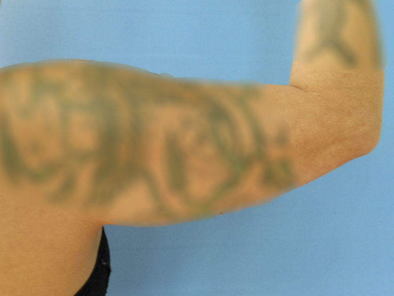 Arms Before & After Gallery - Patient 51821547 - Image 3