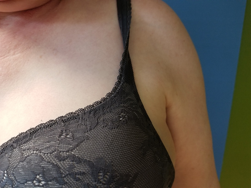 Bra Fat Before & After Gallery - Patient 51821546 - Image 2