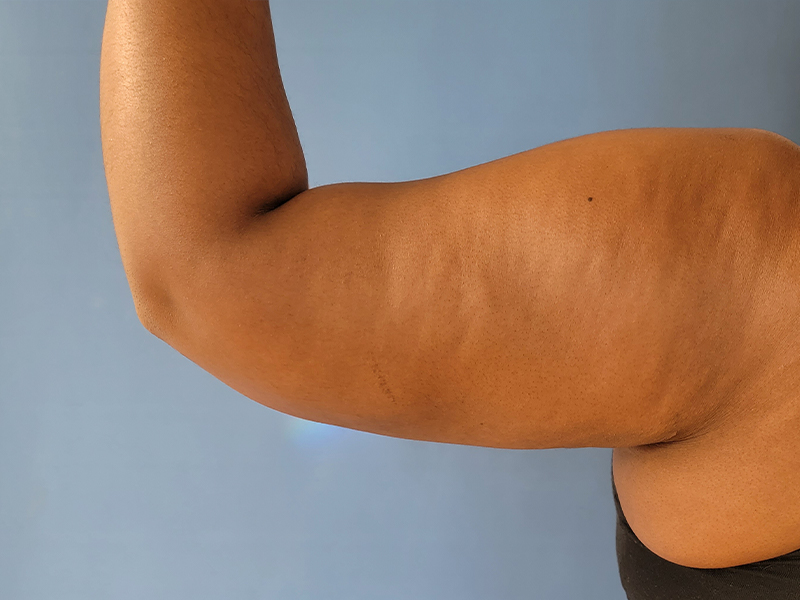 Arms Before & After Gallery - Patient 51821550 - Image 2