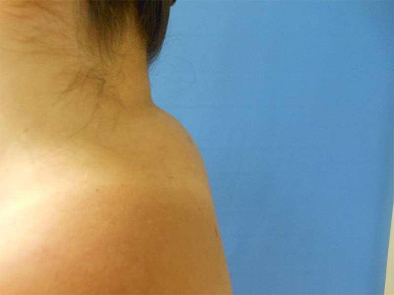 Buffalo Hump Before & After Gallery - Patient 51821549 - Image 1