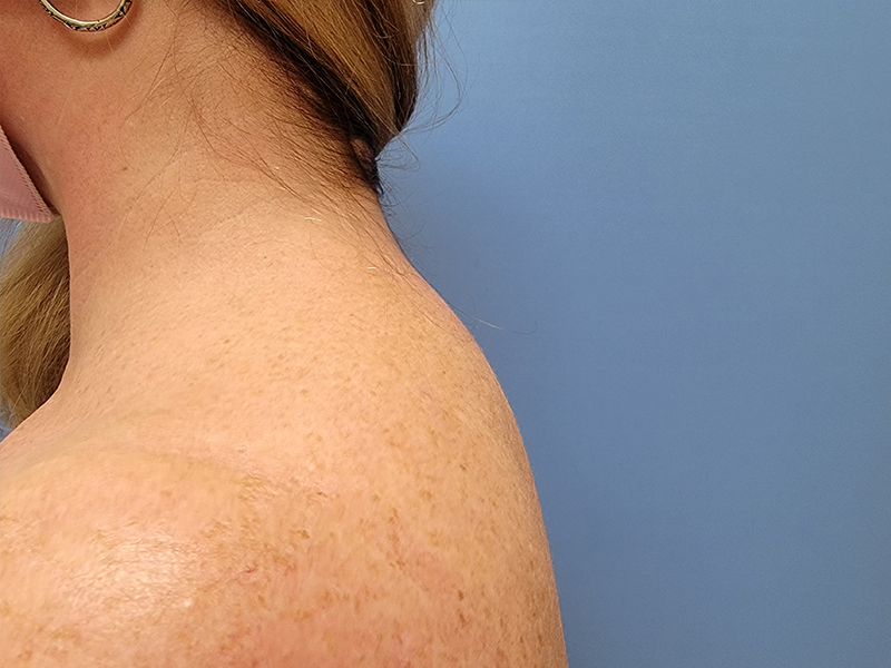 Buffalo Hump Before & After Gallery - Patient 51821552 - Image 2