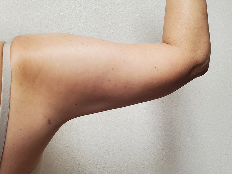 Arms Before & After Gallery - Patient 51821571 - Image 2