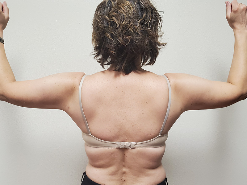 Arms Before & After Gallery - Patient 51821571 - Image 3