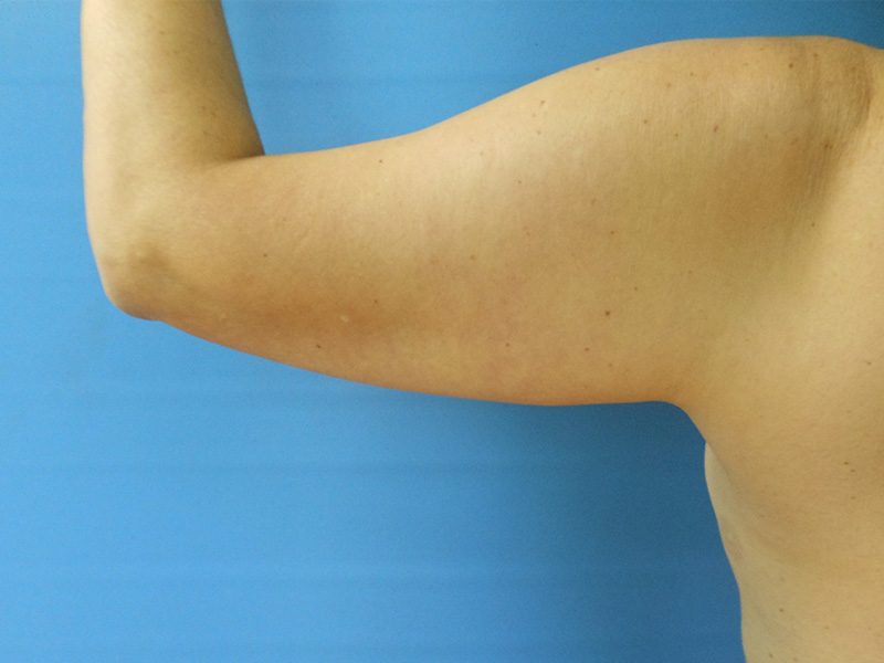 Arms Before & After Gallery - Patient 51821571 - Image 5