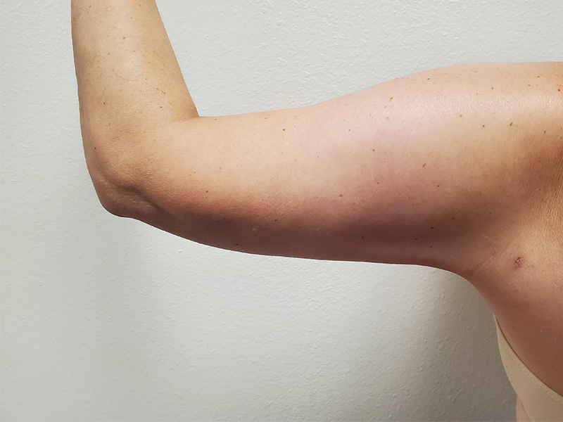 Arms Before & After Gallery - Patient 51821571 - Image 6