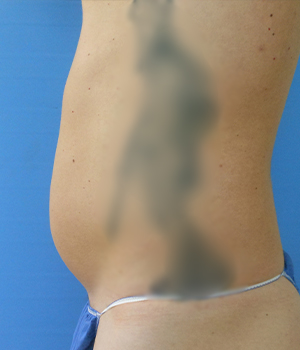 Abdomen Before & After Gallery - Patient 51821586 - Image 1