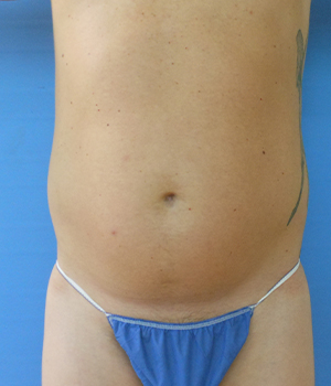 Abdomen Before & After Gallery - Patient 51821586 - Image 3