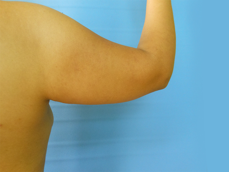 Arms Before & After Gallery - Patient 51821590 - Image 1