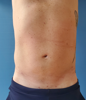 Abdomen Before & After Gallery - Patient 51821586 - Image 4