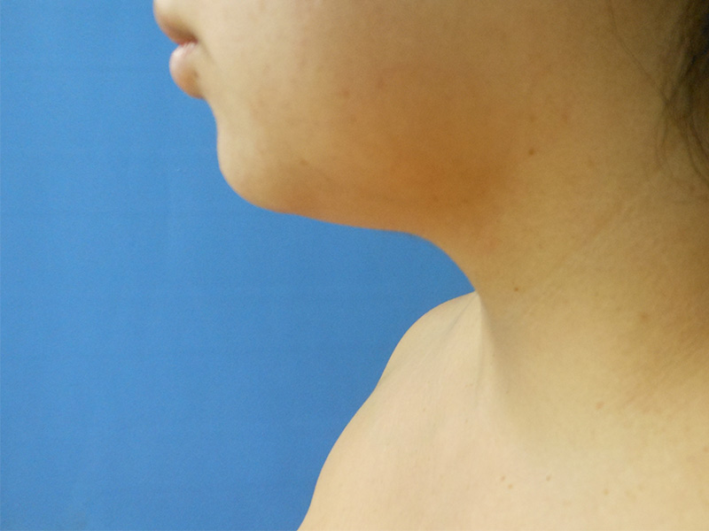 Neck Before & After Gallery - Patient 51821589 - Image 1