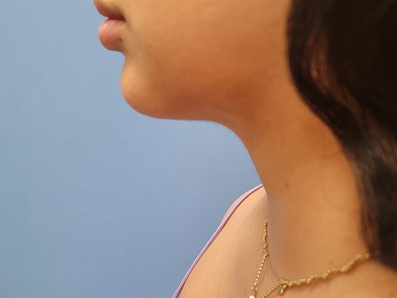 Neck Before & After Gallery - Patient 51821589 - Image 2