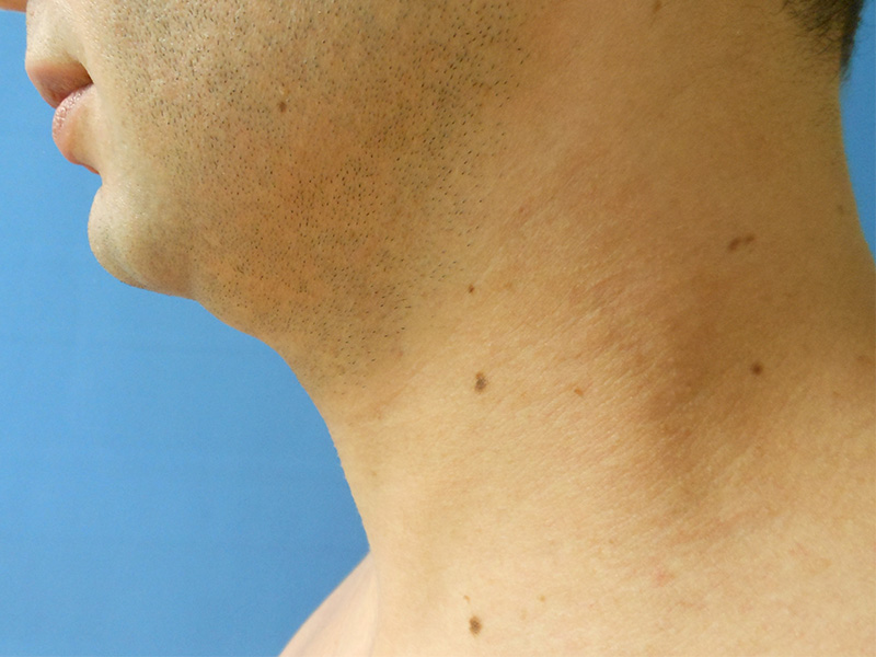 Neck Before & After Gallery - Patient 51821593 - Image 1