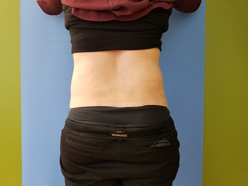 Lower Back Before & After Gallery - Patient 51821594 - Image 2