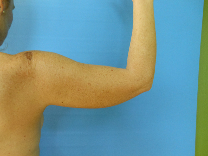 Arms Before & After Gallery - Patient 51821600 - Image 3