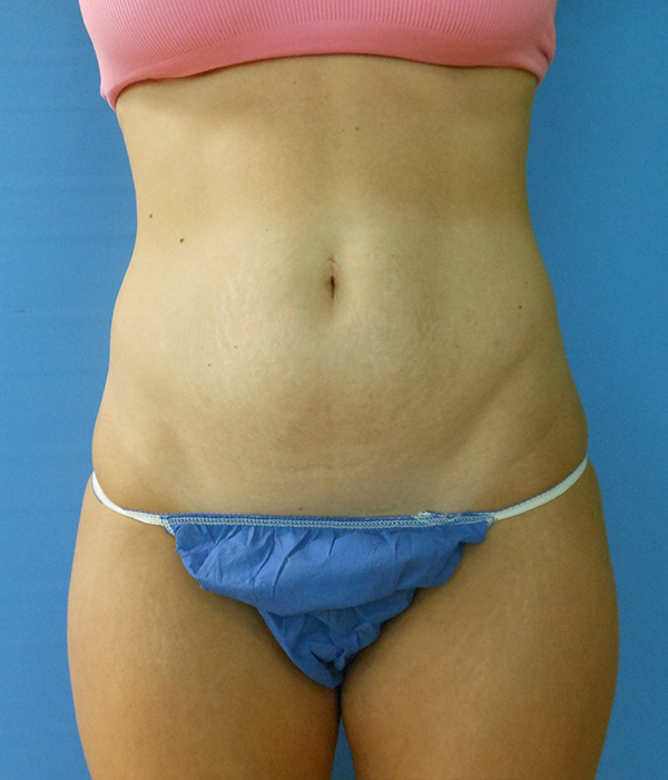 Abdomen Before & After Gallery - Patient 51821599 - Image 3