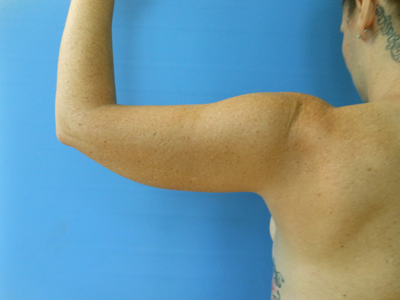 Arms Before & After Gallery - Patient 51821600 - Image 5