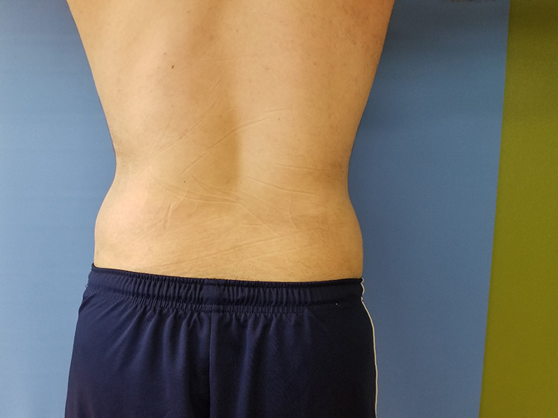 Lower Back Before & After Gallery - Patient 51821597 - Image 2