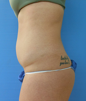 Abdomen Before & After Gallery - Patient 51821605 - Image 1