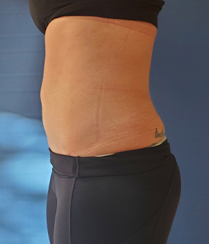 Abdomen Before & After Gallery - Patient 51821605 - Image 2