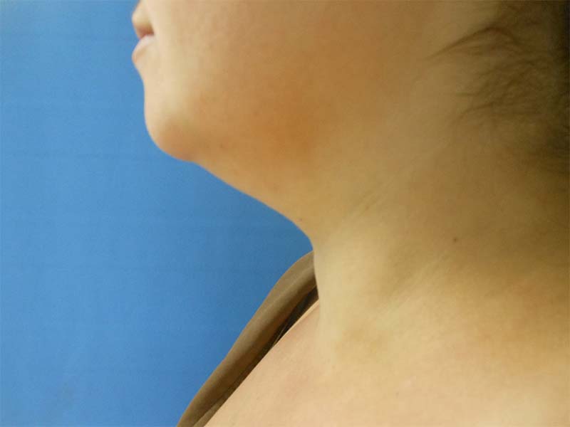 Neck Before & After Gallery - Patient 51821603 - Image 1