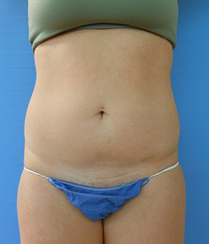 Abdomen Before & After Gallery - Patient 51821605 - Image 3