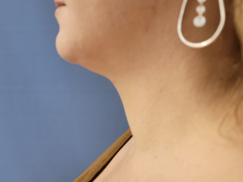 Neck Before & After Gallery - Patient 51821607 - Image 2