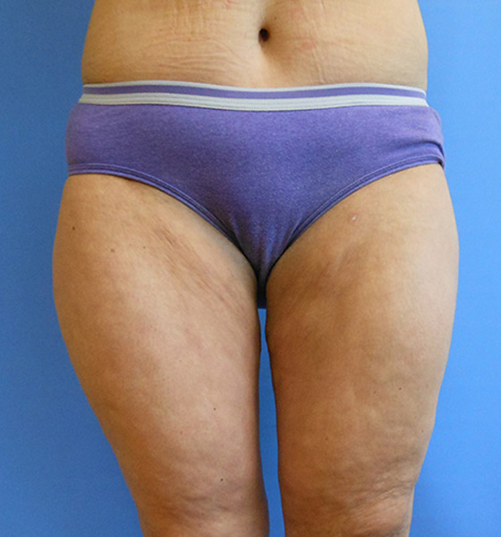 Outer Thigh Before & After Gallery - Patient 51821608 - Image 4