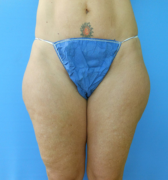 Outer Thigh Before & After Gallery - Patient 51821614 - Image 1