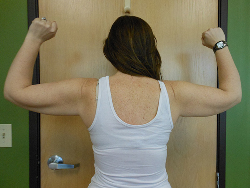 Arms Before & After Gallery - Patient 51821615 - Image 2