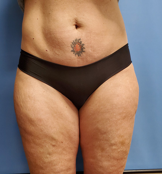 Outer Thigh Before & After Gallery - Patient 51821614 - Image 2