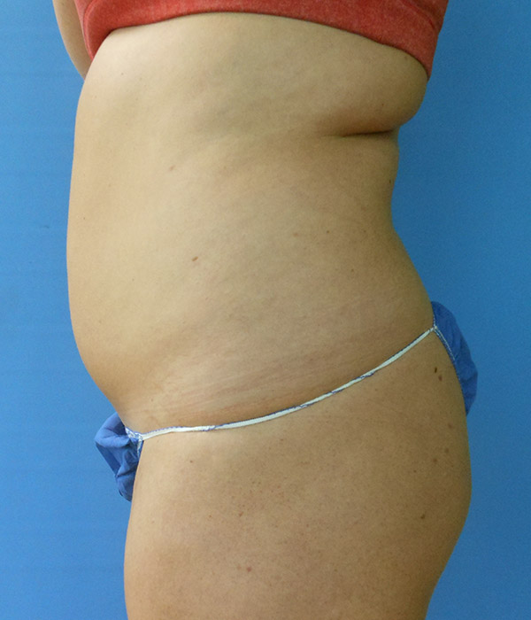 Liposuction Before and After Photo Gallery, San Diego, CA