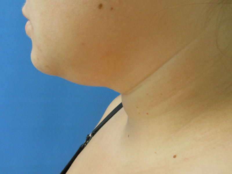 Neck Before & After Gallery - Patient 51821616 - Image 1