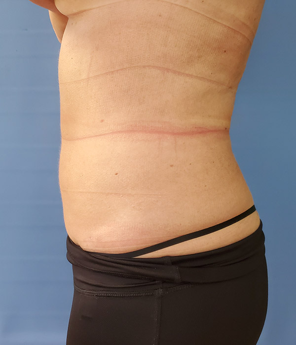 Abdomen Before & After Gallery - Patient 51821620 - Image 2