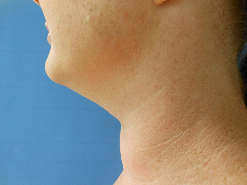 Neck Before & After Gallery - Patient 51821619 - Image 1