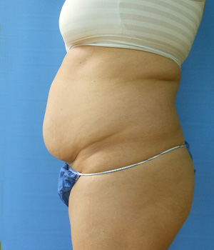 Abdomen Before & After Gallery - Patient 51821622 - Image 1