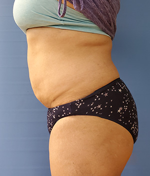 Abdomen Before & After Gallery - Patient 51821622 - Image 2