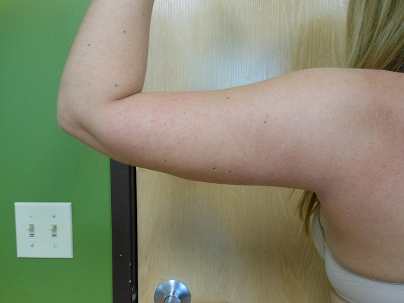 Arms Before & After Gallery - Patient 51821626 - Image 6