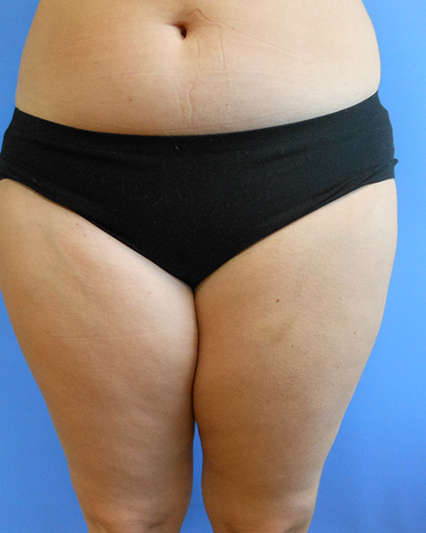 Outer Thigh Before & After Gallery - Patient 51821624 - Image 2