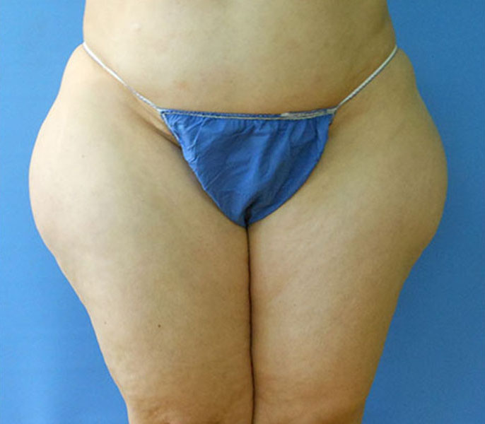 Outer Thigh Before & After Gallery - Patient 51821627 - Image 1